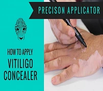 Vitiligo yashiruvchi Zanderm Vitiligo yashiruvchi
