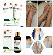VITILIGO ni davolash uchun damlamasi - Yansuan Danjie Ding