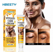 Vitiligo kremi Vitiligo Care Cream HBESTY