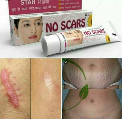 Крем для удаления шрамов No Scars:uz:Izlarni olib tashlash uchun krem No Scars